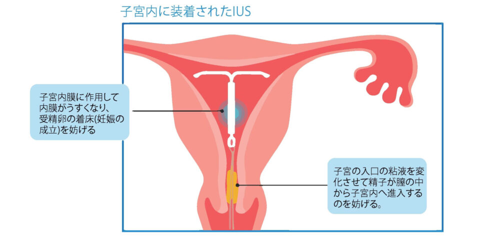子宮内に装着されたIUS
・子宮内膜に作用して内膜がうすくなり、受精卵の着床（妊娠の成立）を妨げる
・子宮の入り口の粘液を変化させて精子が腟の中から子宮内へ侵入するのを妨げる。